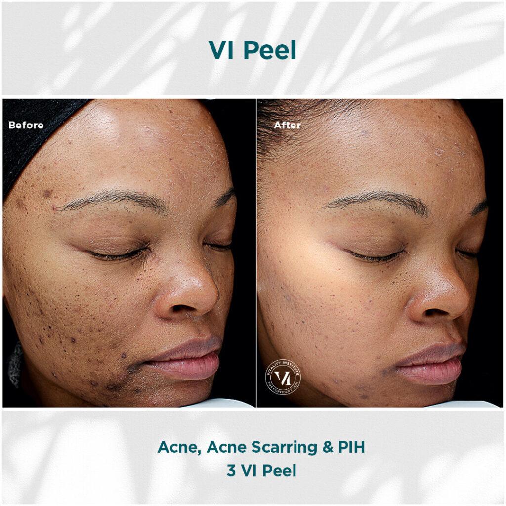 Chemical-Peel-Before-and-After
