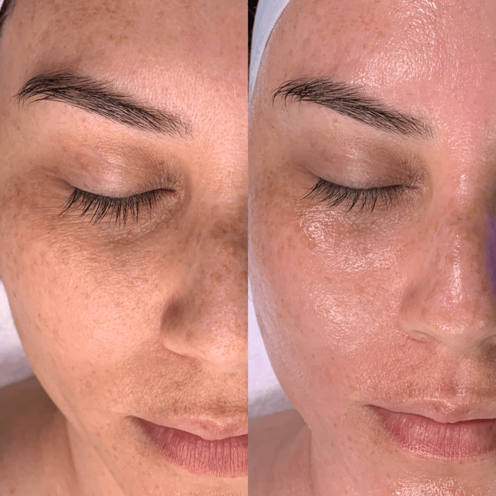 before-and-after-a-HydraFacial