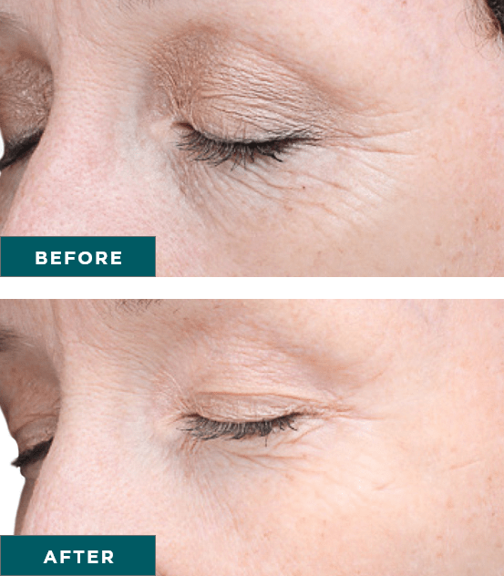 VI-Peel-Advanced-before-and-after