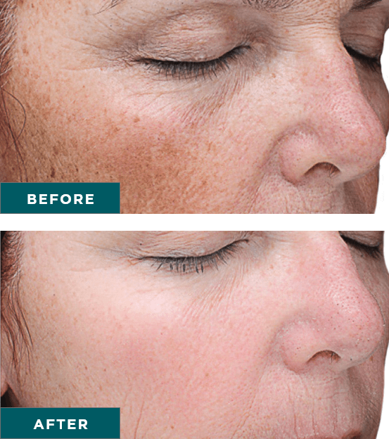VI-Peel-Precision-Plus-before-and-after
