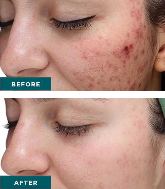 VI-Peel-Purify-with-Precision-Plus-before-and-after